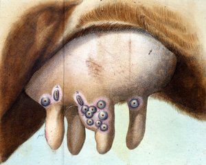 A Luigi Sacco (1769-1836) himlőoltás beoltására használt tehénmell 1801 januárjában. Orvosi lemez a „” Vaccination Treat”-től, Luigi Sacco, Milánó alkotó: Unknown artist