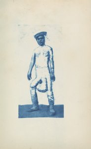 Elefantiázis,c. 1870-es évek (fotó) alkotó: Unknown photographer