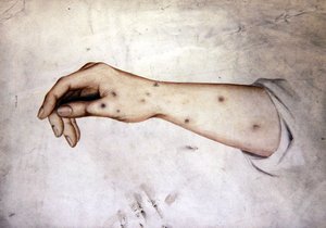 Egy alkar vizsgálata bőrbetegséggel, 1850 körül (akvarell papíron) alkotó: William Lover