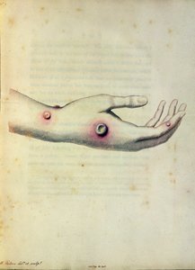 Tehénhimlő pustule Sarah Nelmes karján, Edward Jenner (1749-1823) „A Variolae Vaccinae okainak és következményeinek vizsgálata” című könyvéből, Pearce metszetében, 1800 körül
