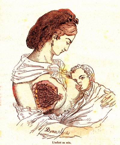 A gyermek a mellben (J. Rengade normál élete és egészsége) - Szoptatás. A. Demarle rajza 1881 alkotó: Alphonse Demarle