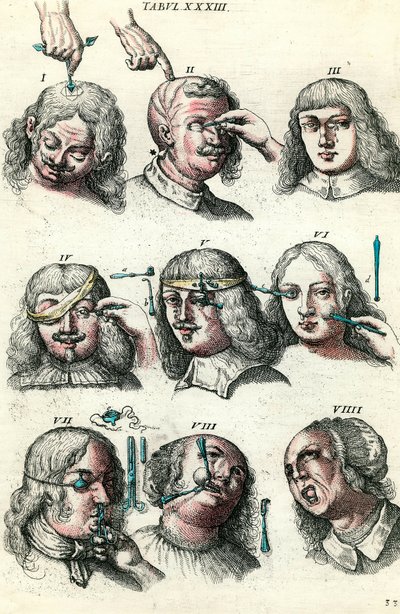 Sebészet a 18. században: A szem és az arc trepanációja, műtétje. Metszet Lorenz Heister „Institutions chirurgicale”-ba alkotó: Anonymous Anonymous