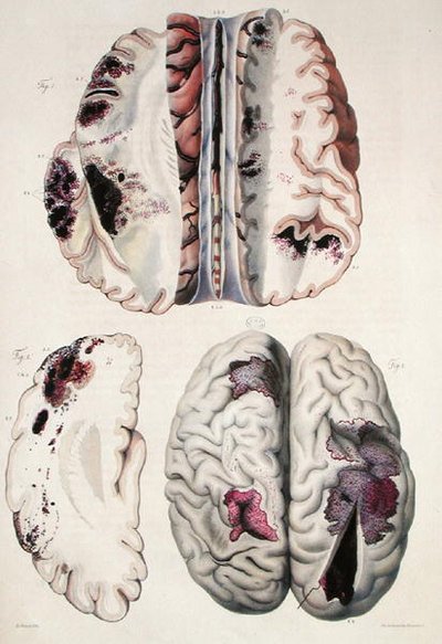 Kapilláris apoplexia, Jean Cruveilhier (1791-1874) „Anatomie Pathologique du Corps Humain” című művéből, 1828-42 (színes metszet) alkotó: Antoine Chazal