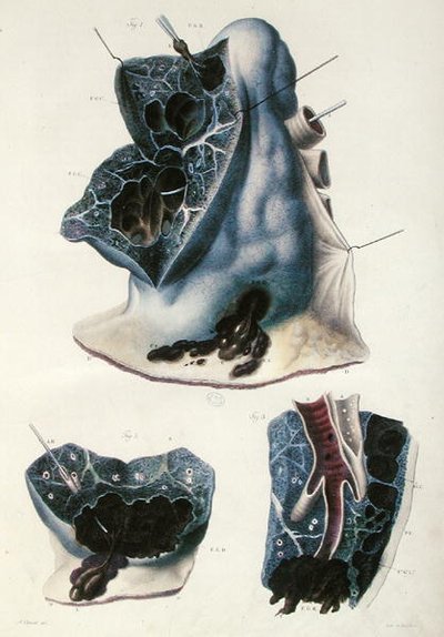 A tüdő betegségei, Jean Cruveilhier (1791-1874) "Anatomie Pathologique du Corps Humain" című művéből, 1828-42 (színes metszet). alkotó: Antoine Chazal