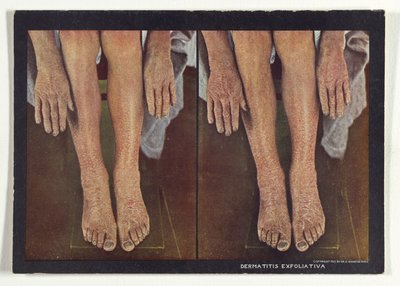 Dermatitis Exfoliativa alkotó: Dr. Selden I. Rainforth