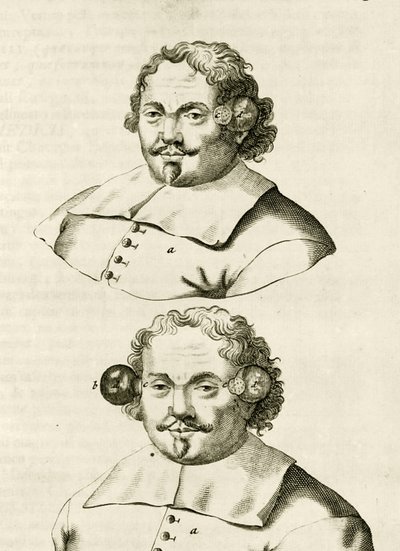 Egy példa a köpölyözésre, Frederik Dekkers The Practice of Medicine című könyvéből, 1694 alkotó: Dutch School