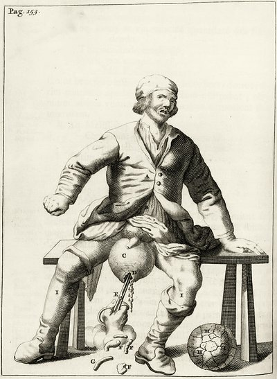 Folyadék elvezetése a herezacskó hidroceléjéből, abból alkotó: Dutch School