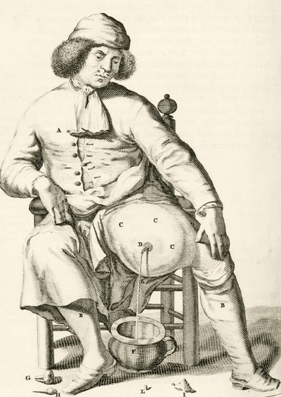 Folyadék leeresztése tályogból Frederik Dekkers, 1694 alkotó: Dutch School