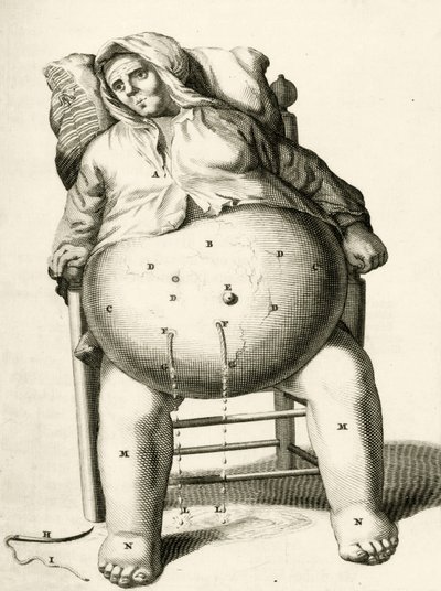 Folyadékleeresztés egy tályogból Frederik Dekkers, 1694 alkotó: Dutch School