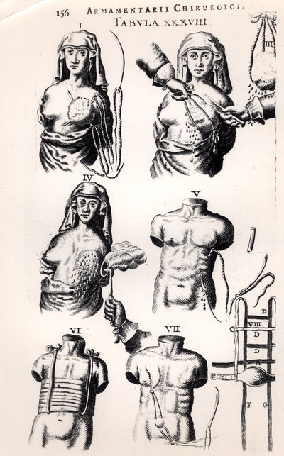 Mellrák műtét, Johannes Schultes (1595-1645) Armamentarii Chirurgici című művéből, Amszterdamban, 1672-ben alkotó: Dutch School