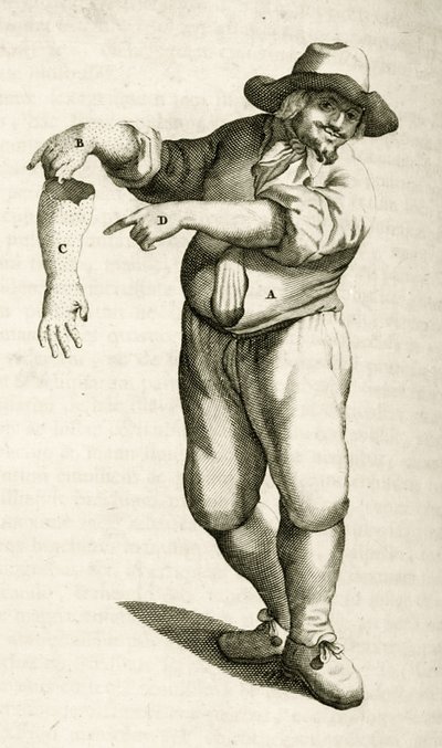 Elhalt bőr eltávolítása pustulákkal, Frederik Dekkers Gyakorlati gyakorlatai az orvosi módszerekből, 1694 alkotó: Dutch School