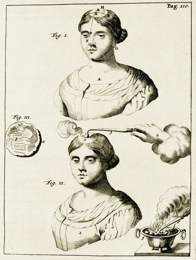 Epilepsziában szenvedő betegek kezelése Frederik Dekkers gyakorlataiból az orvosi gyakorlatban, 1694 alkotó: Dutch School