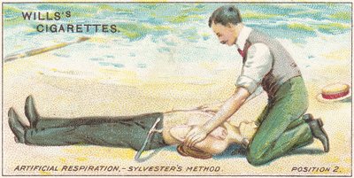 Mesterséges lélegeztetés, Sylvester módszere – 2. pozíció, 17. sz. a Wills