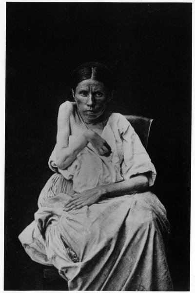 Fénykép egy féloldali epilepsziában szenvedő betegről, a Salpetrière, Bourneville és P. Regnard, Párizs „” fényképes ikonográfiájában alkotó: French Photographer