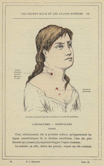 A scrofulosis jellegzetes balesetei a másodlagos időszakban (színes litho) alkotó: French School
