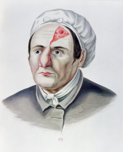 Bőrátültetés után, Alexander Auvert Selecta Praxis Medico-Chirurgica cégétől, Párizs, 1856 alkotó: French School