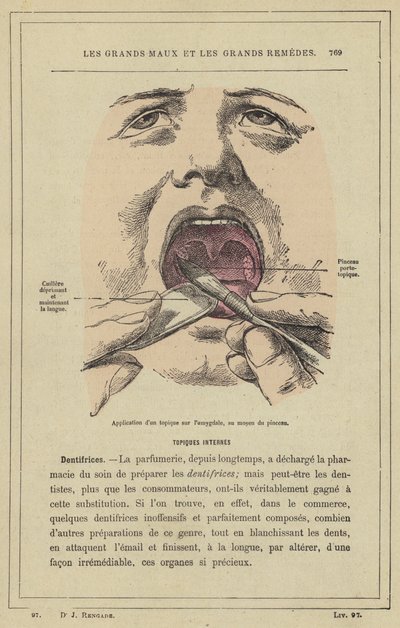 Helyileg alkalmazható készítmény felvitele a mandulára ecsettel (színes litho). alkotó: French School