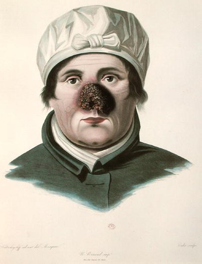 Bőrátültetés előtt, Alexander Auvert „Selecta Praxis Medico-Chirurgica”-tól, Párizs alkotó: French School