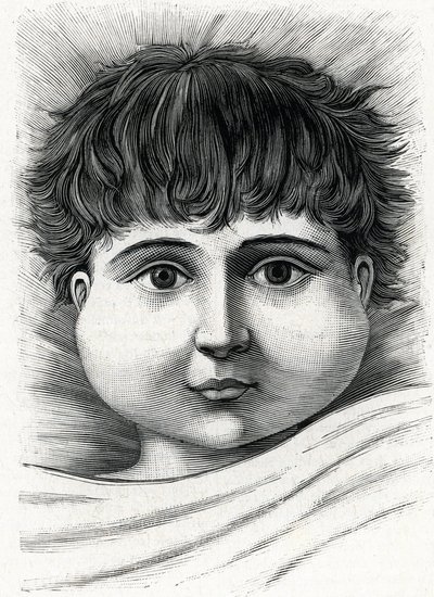 Mumpszos gyermek (metszet) 1888 alkotó: French School