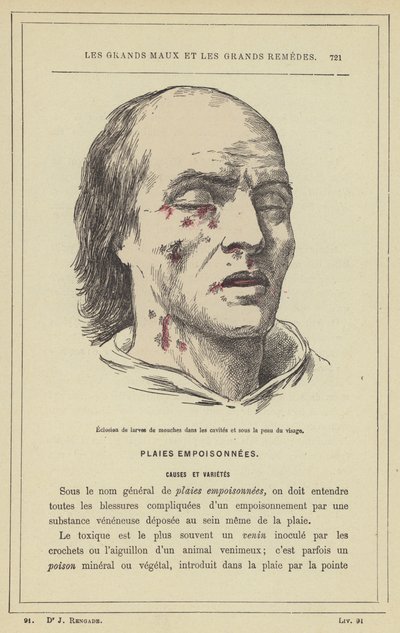 Légylárvák kikelése az üregekben és az arc bőre alatt (színes litho) alkotó: French School