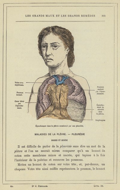 Mellhártyagyulladás által okozott effúzió a mellhártyában (színes litho) alkotó: French School