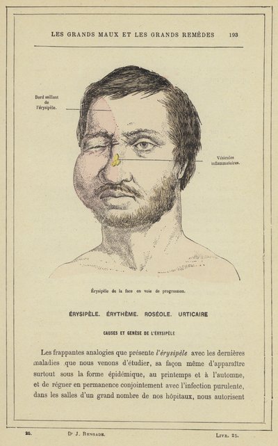 Progresszív erysipela arcra (színes litho) alkotó: French School