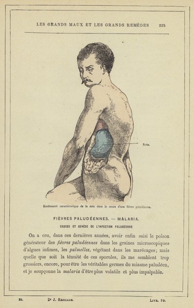 A lép jellegzetes duzzanata maláriás láz során (színes litho) alkotó: French School