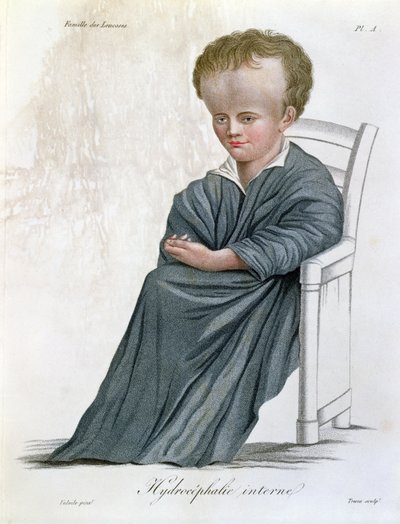 Belső Hydrocephalus, a Nosologie Naturelle-ből, Jean Louis Alibert báró (1768-1837) vésette Tresca, 1817 alkotó: French School