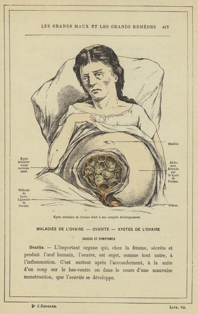 A jobb petefészek areoláris cisztája teljes kifejlődésben (színes litho) alkotó: French School