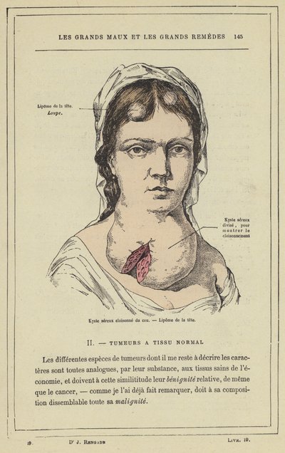 Cloisonne savós ciszta a nyakon, lipoma a fejen (színes litho) alkotó: French School