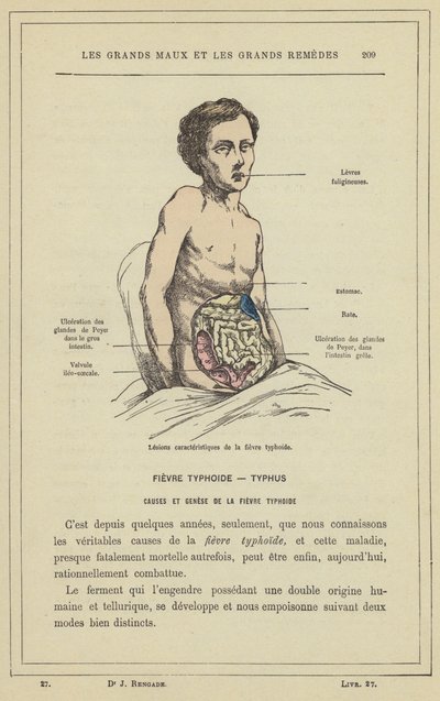 A tífusz jellegzetes elváltozásai (színes litho) alkotó: French School