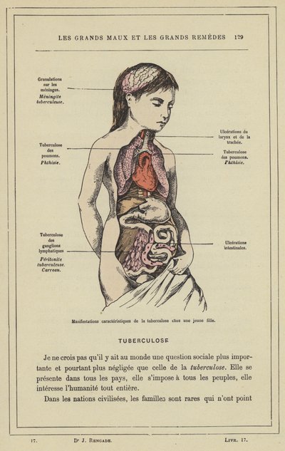 A tuberkulózis jellegzetes megnyilvánulásai egy fiatal lányban (színes litho) alkotó: French School