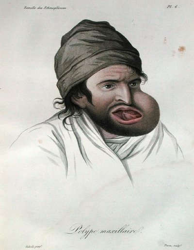 Maxilláris polip, báró Jean Louis Alibert (1768-1837) könyvéből, 1817 (színes metszet) alkotó: French School