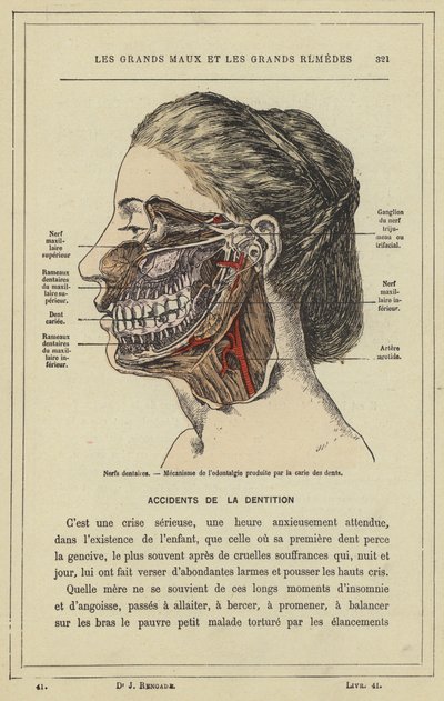 Fogidegek, A fogszuvasodás által okozott odontalgia mechanizmusa (színes litho) alkotó: French School