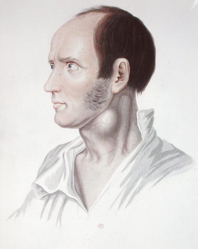 Aneurizmás beteg, Alexander Auvert "Selecta Praxis Medico-Chirurgica" című művéből, Párizs, Párizs alkotó: French School