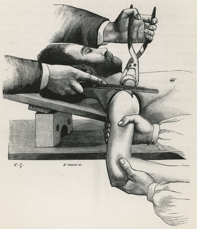 A váll reszekciója, Louis-Hubert Farabeuf „Précis de Manuel Operatoire” című művéből alkotó: French School