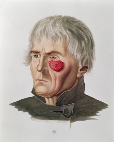 Bőrbetegség műtét előtt, Alexander Auvert Selecta Praxis Medico-Chirurgica-ból, Párizs, 1856 alkotó: French School