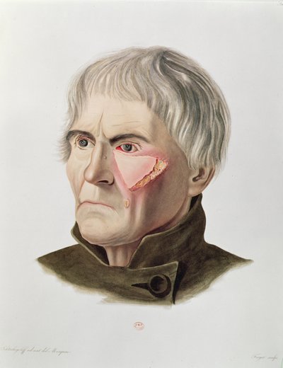 Bőrátültetés műtét, a Selecta Praxis Medico-Chirurgica cégtől, Alexander Auvert, Párizs, 1856 alkotó: French School