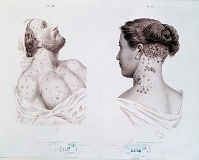 A szifilisz tünetei férfiaknál és nőknél, egy orvosi könyvből, 1850-60 körül alkotó: French School