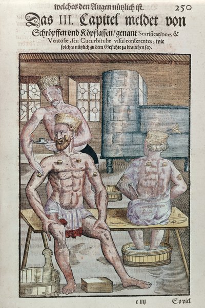 Georg Bartisch (1535-1636) köpölyözése, az Ophthalmodouleia-ból, Drezdában 1583-ban (színes fatömbnyomat) alkotó: German School