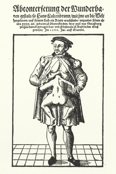 Hans Kaltenbrunn és fejletlen, összenőtt ikertestvére (metszet) alkotó: German School