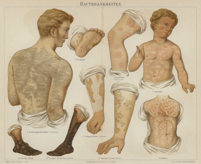 Bőrbetegségek (színes litho) alkotó: German School