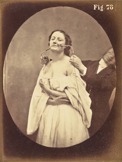 Ábra. 78 alkotó: Guillaume-Benjamin Duchenne