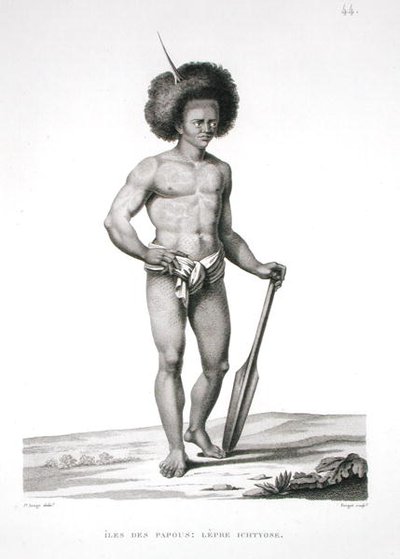 Pápua-szigetek: Lepra áldozata, a „Voyage Autour du Monde (1817-20)”-ból, Louis Claude Desaulses de Freycinet (1779-1842) vésette Forget, megjelent 1822-24 (litho) alkotó: Jacques Etienne Victor (after) Arago