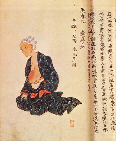 Seishu Hanaoka (1760-1836) az emlőrák első sebészeti kezelését általános érzéstelenítésben végezte 1804-ben alkotó: Japanese School