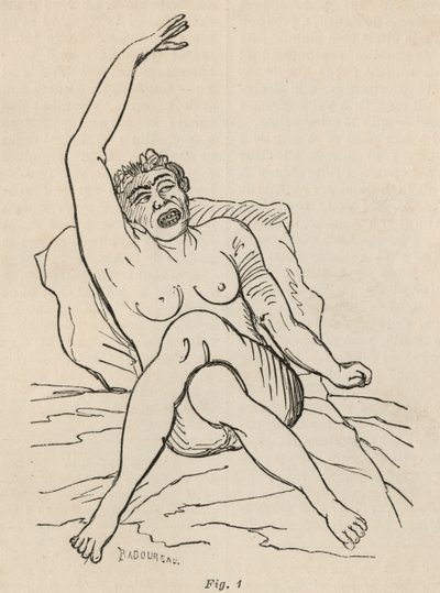 Hisztérikus epilepszia, roham, görcsök, 1. ábra a Bourneville et P. által készített "Iconographie Photographique de La Salpetriere" című képből. Regnard, Párizs, 1876 alkotó: Jean Francois Badoureau