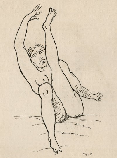 Hisztérikus epilepszia, roham, torzulások, ábra. 2. Bourneville és P. Regnard „Iconographie Photographique de La Salpetriere” című művéből, Párizs, 1876 alkotó: Jean Francois Badoureau