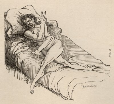 Hisztérikus epilepszia, roham, torzulások, ábra. 3. Bourneville és P. Regnard „Iconographie Photographique de La Salpetriere” című művéből, Párizs, 1876 alkotó: Jean Francois Badoureau