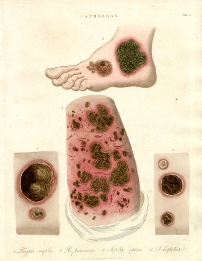 Kóros bőrbetegségek - Pityria;Impetigo és szifilisz alkotó: John Pass