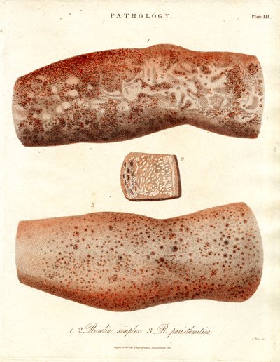 Bőrkitörések - Roseola simplex és Roseola paristhmitica alkotó: John Pass